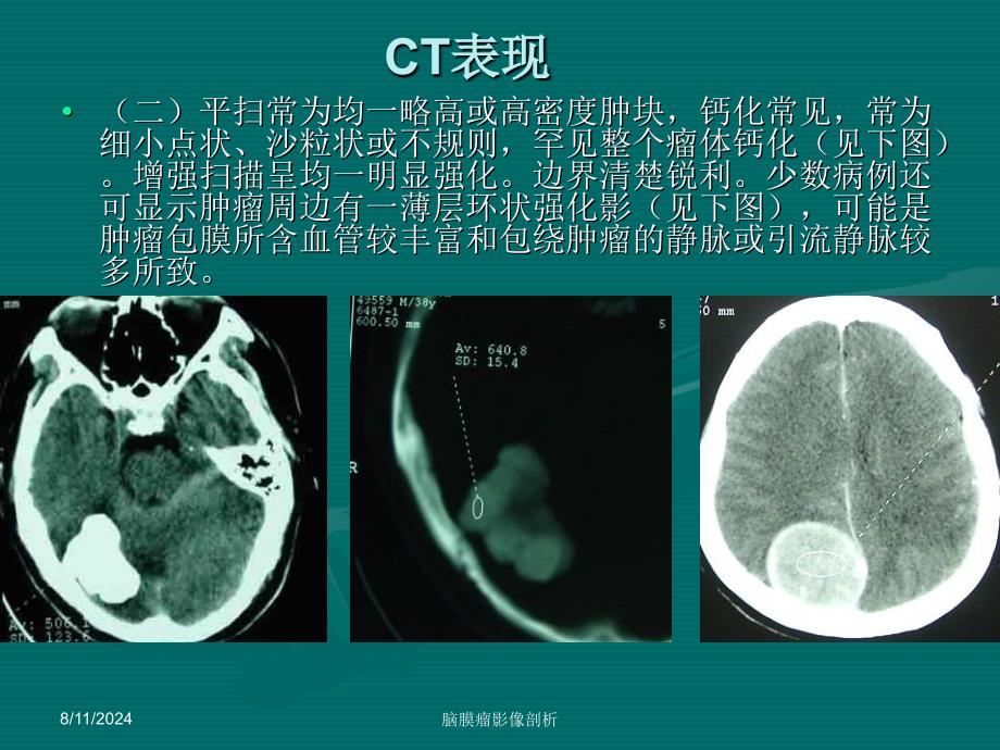 脑膜瘤CT、MRI表现_第4页