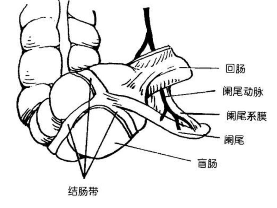 急性阑尾炎PPT_第5页