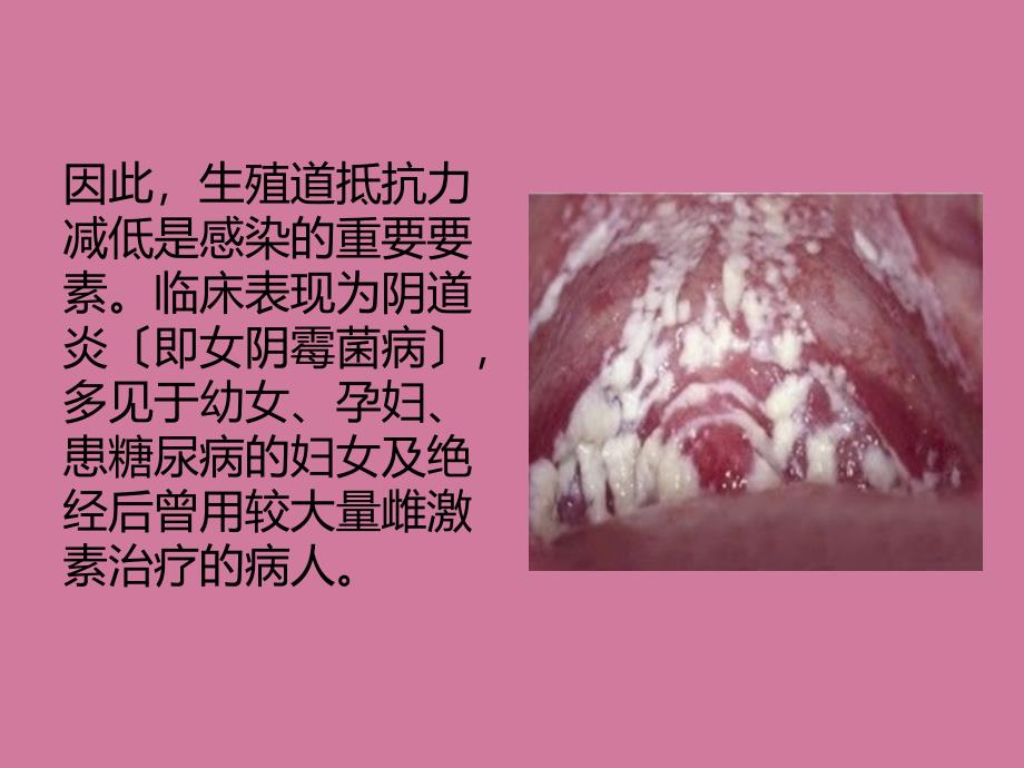 霉菌性阴炎症状ppt课件_第3页