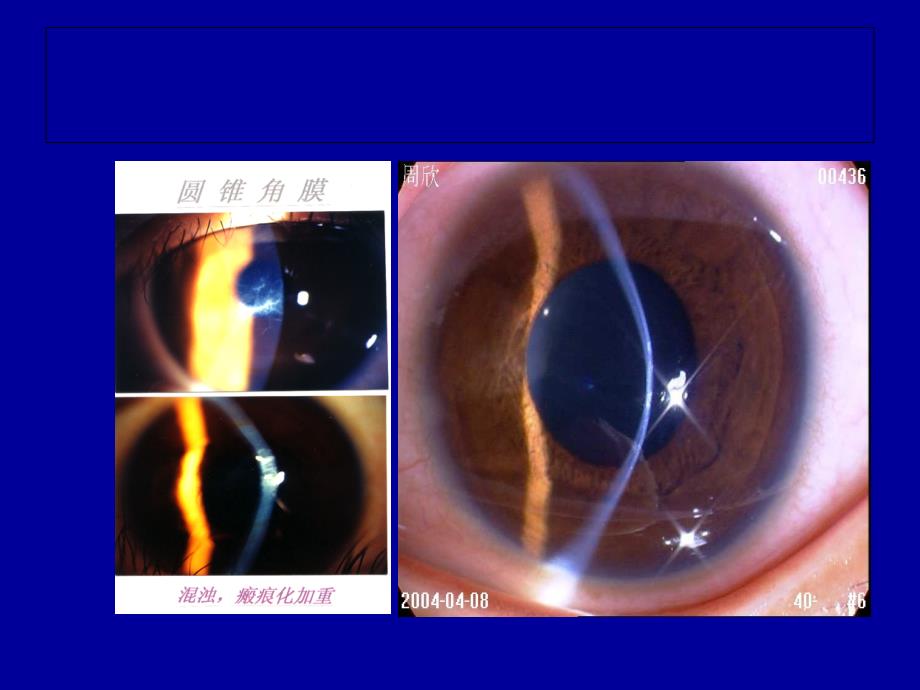 角膜地形图解析.ppt_第4页