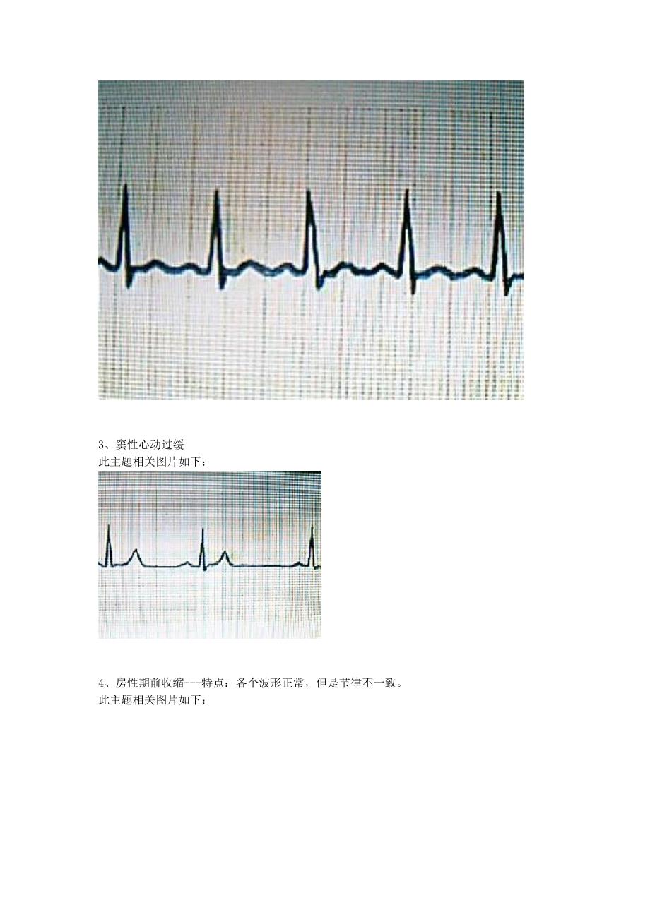 巧记心电图 2012.doc_第3页