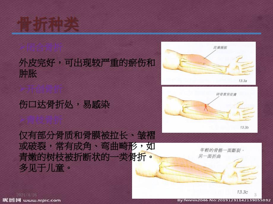 急救-骨折的急救处理与搬运教学课件_第3页