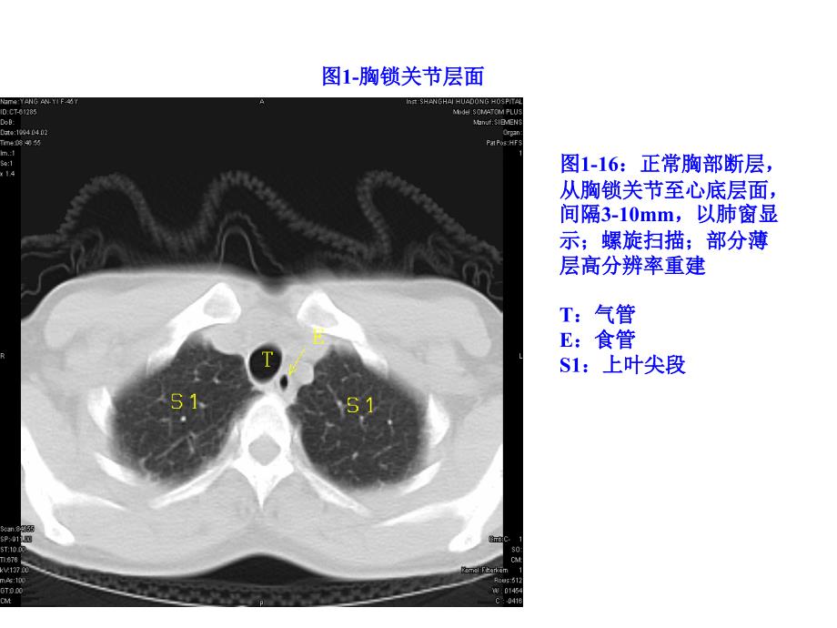 正常胸部CTWXMPPT课件_第2页