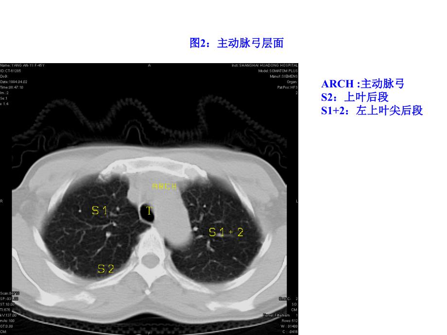 正常胸部CTWXMPPT课件_第3页