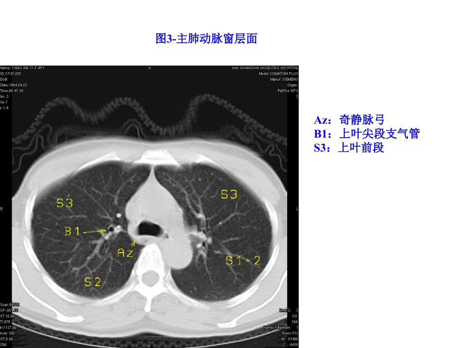 正常胸部CTWXMPPT课件_第4页