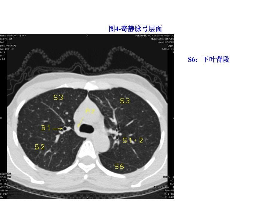 正常胸部CTWXMPPT课件_第5页