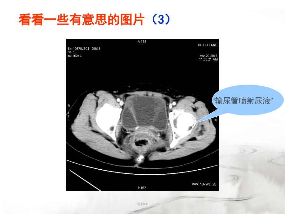 腮腺常见疾病的CT诊断-王传彬_第4页