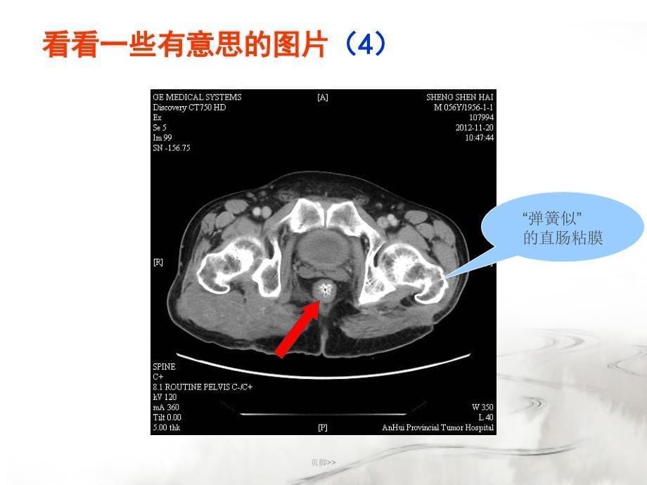 腮腺常见疾病的CT诊断-王传彬_第5页