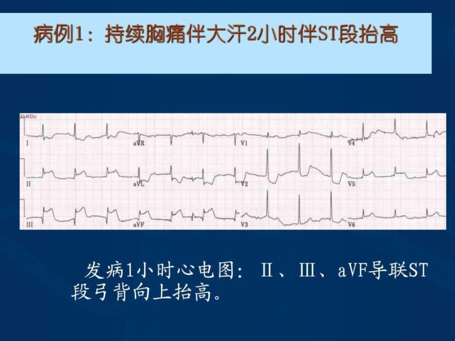 急性心肌梗死的紧急救治.ppt_第4页