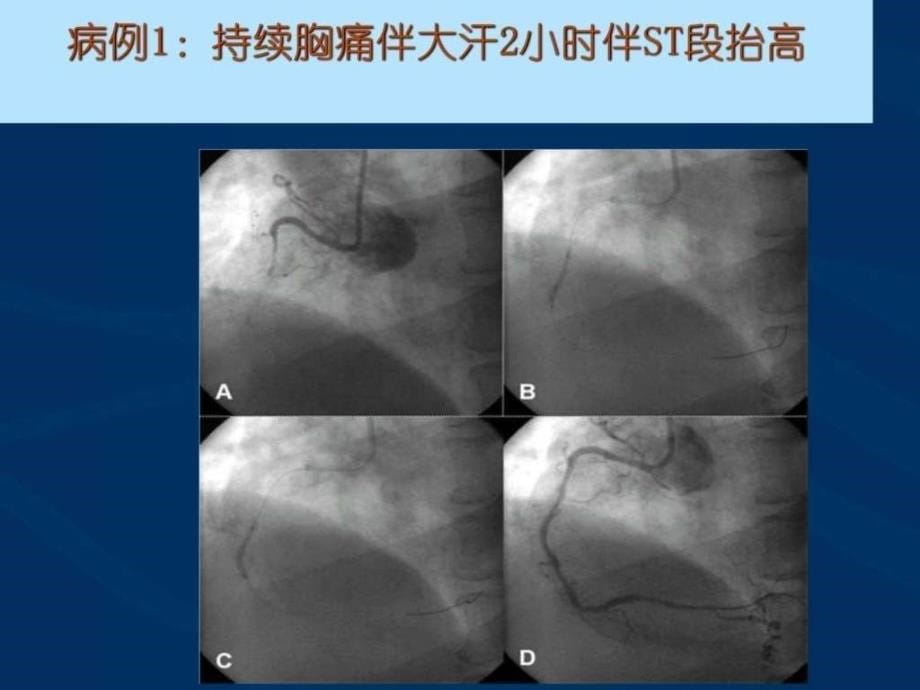 急性心肌梗死的紧急救治.ppt_第5页