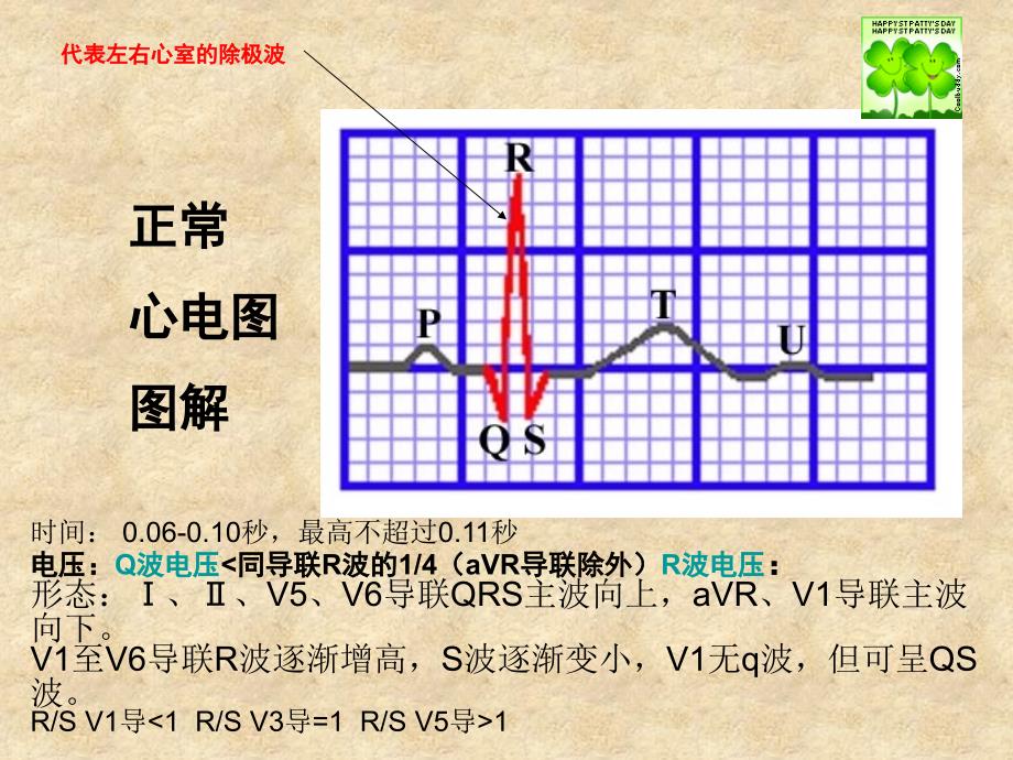 常见心律失常的心电图识别_第4页