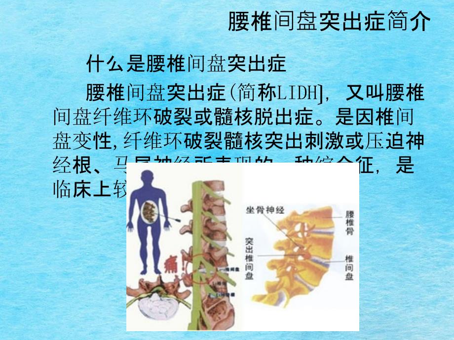 浅谈腰间盘突出病理及治疗ppt课件_第3页