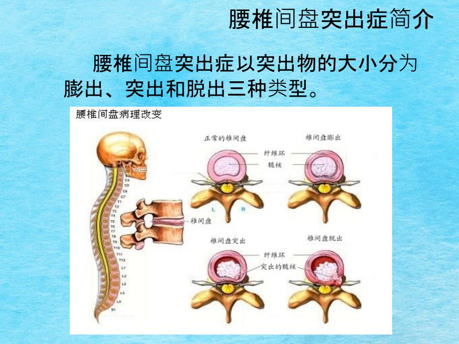 浅谈腰间盘突出病理及治疗ppt课件_第4页