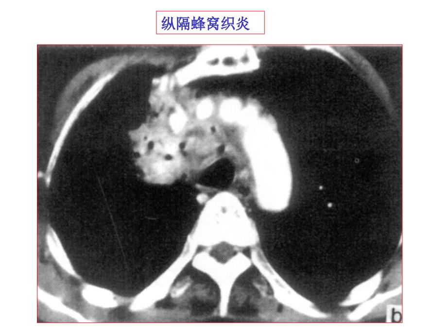 纵膈常见疾病的CT表现_第3页