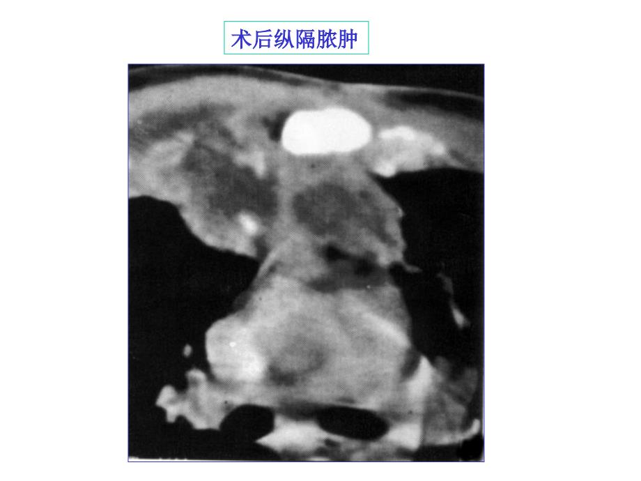 纵膈常见疾病的CT表现_第4页