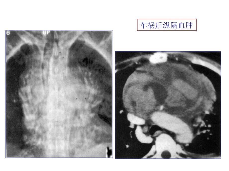 纵膈常见疾病的CT表现_第5页