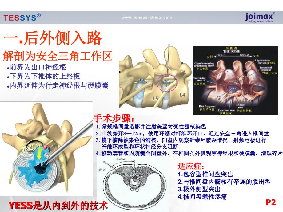 椎间孔镜技术的历史及现状ppt课件_第3页