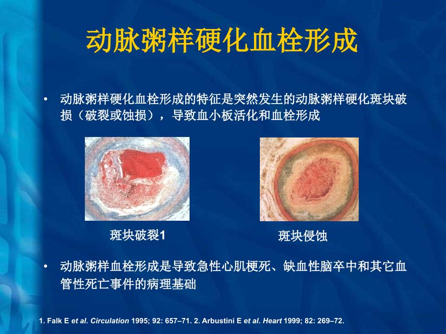 非ST抬高急性冠脉综合征的诊治进展课件_第4页