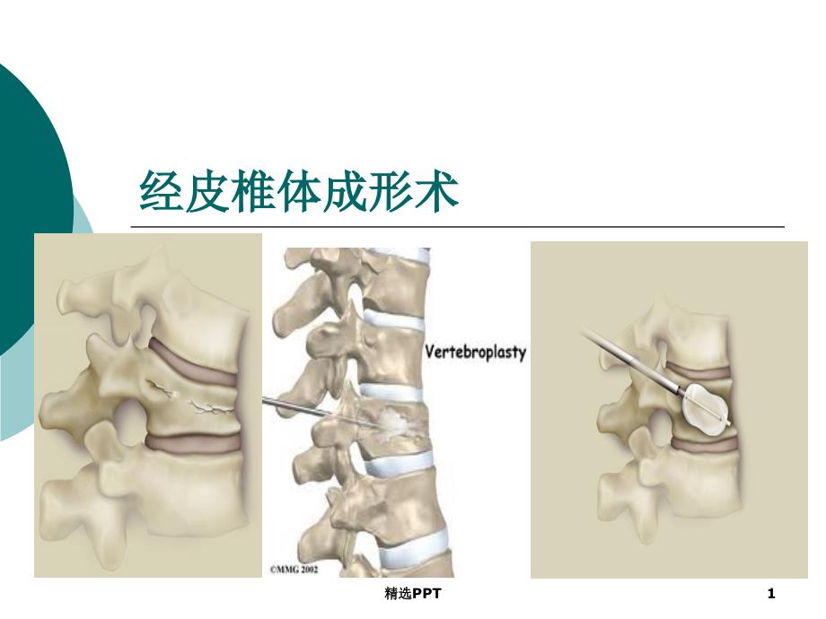 经皮椎体成形术课件_第1页