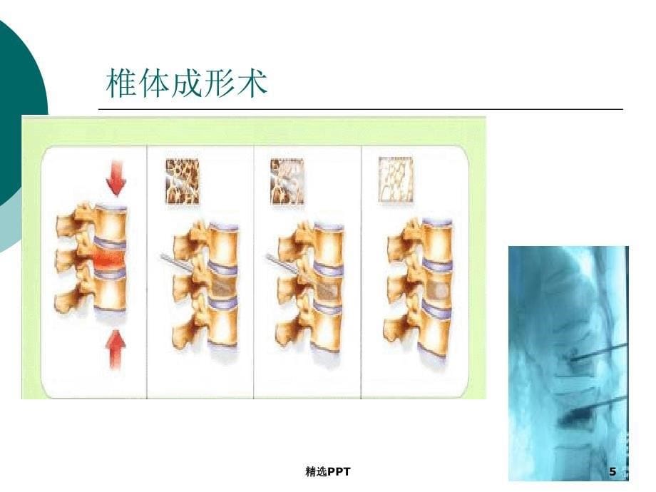 经皮椎体成形术课件_第5页