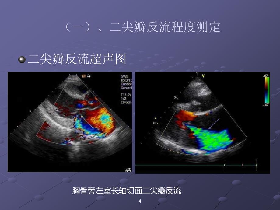 图解超声心动图评估瓣膜反流程度ppt课件_第4页