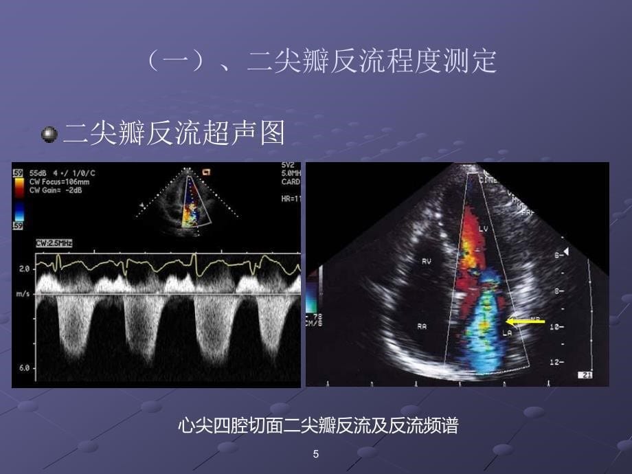 图解超声心动图评估瓣膜反流程度ppt课件_第5页