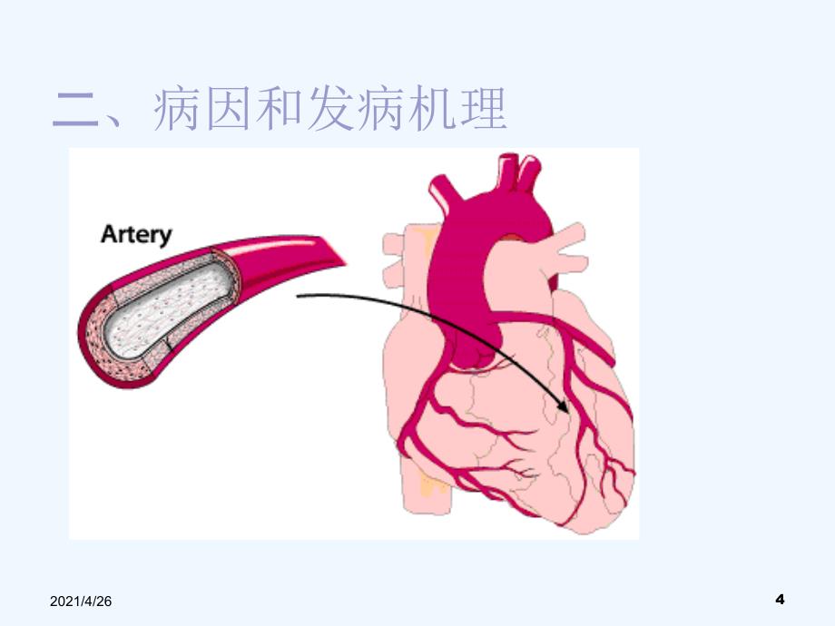 急性心肌梗死_第4页