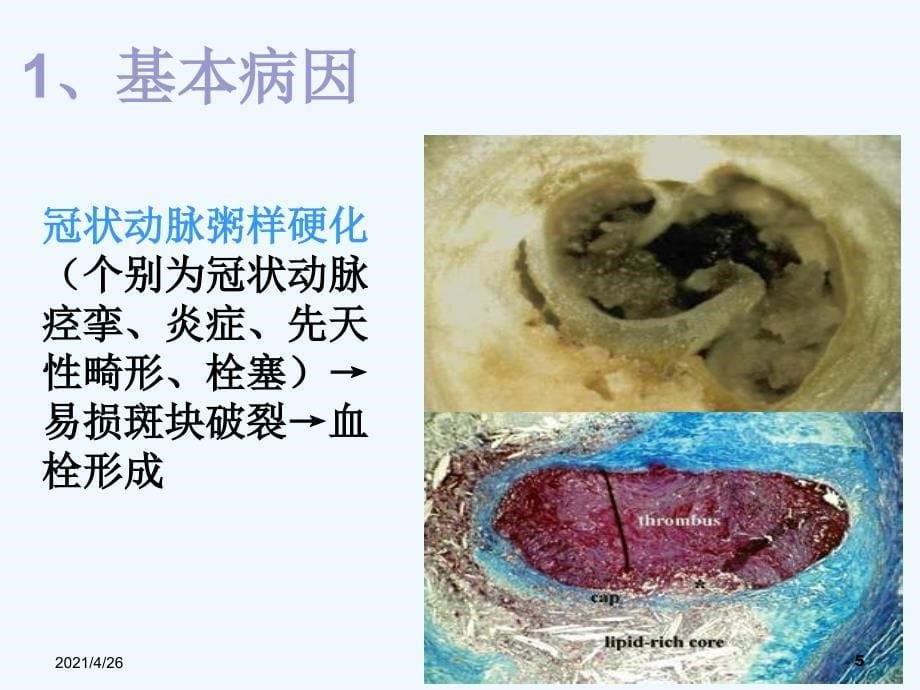 急性心肌梗死_第5页