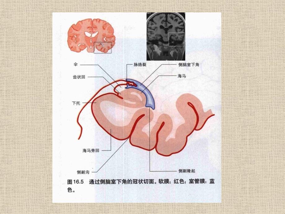 MR脑脉络膜裂囊肿的影殷艳霞_第4页