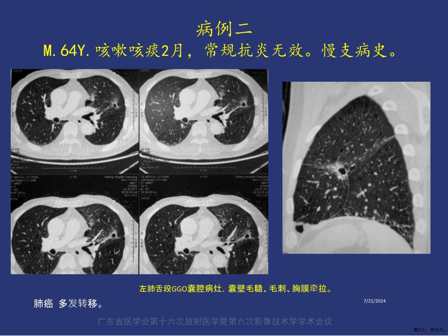 薄壁囊腔型肺癌的影像诊断和鉴别诊断课件(PPT 41页)_第3页