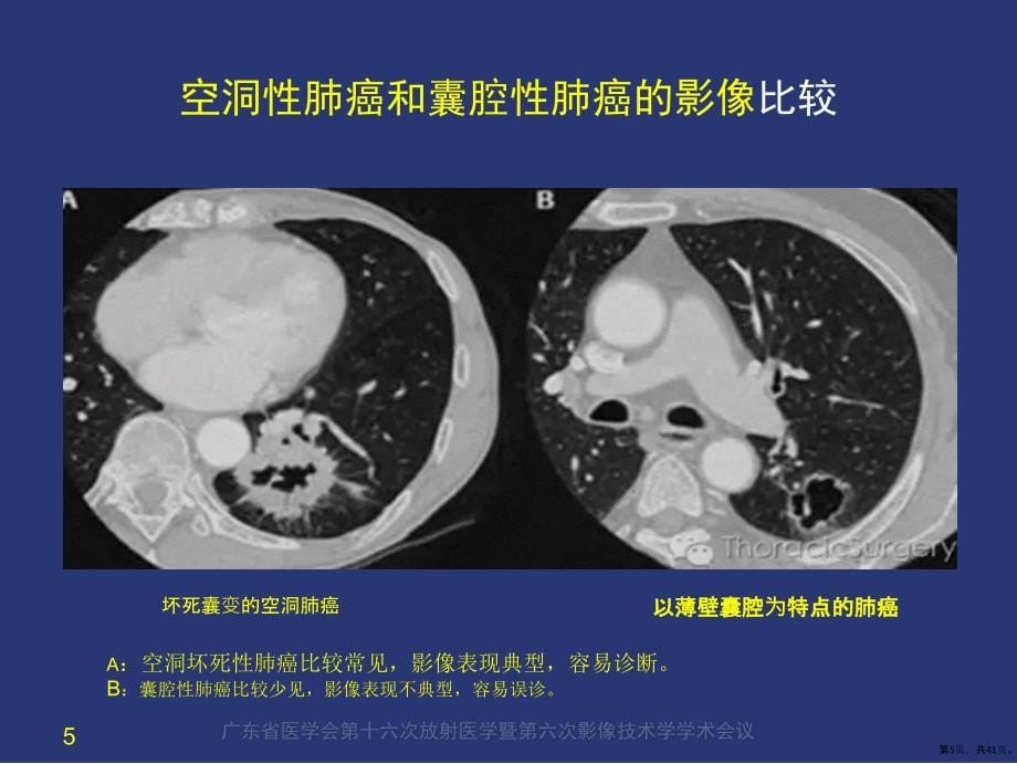 薄壁囊腔型肺癌的影像诊断和鉴别诊断课件(PPT 41页)_第5页