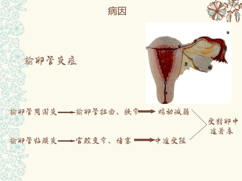 异位妊娠完整版_第5页