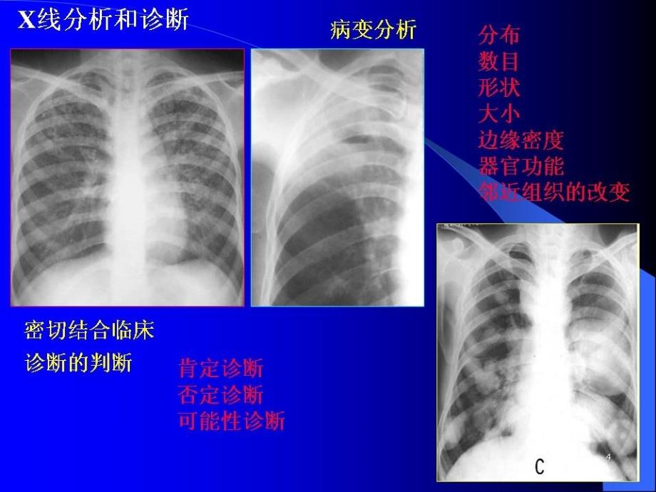 精选课件如何阅读胸片_第4页