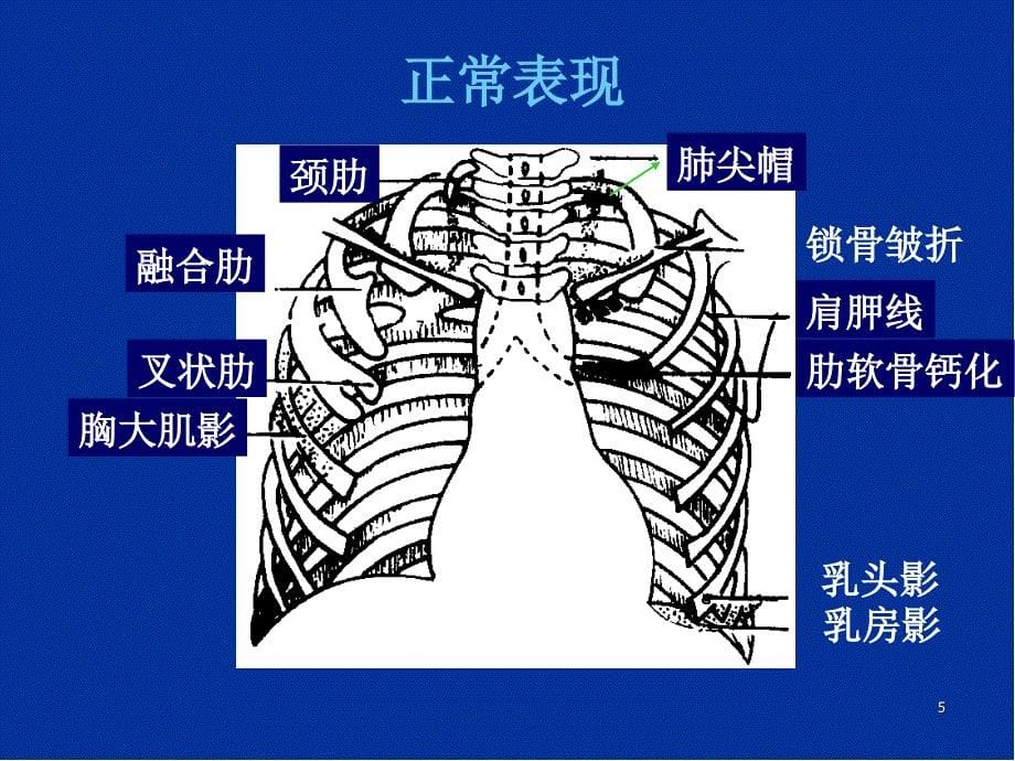 精选课件如何阅读胸片_第5页