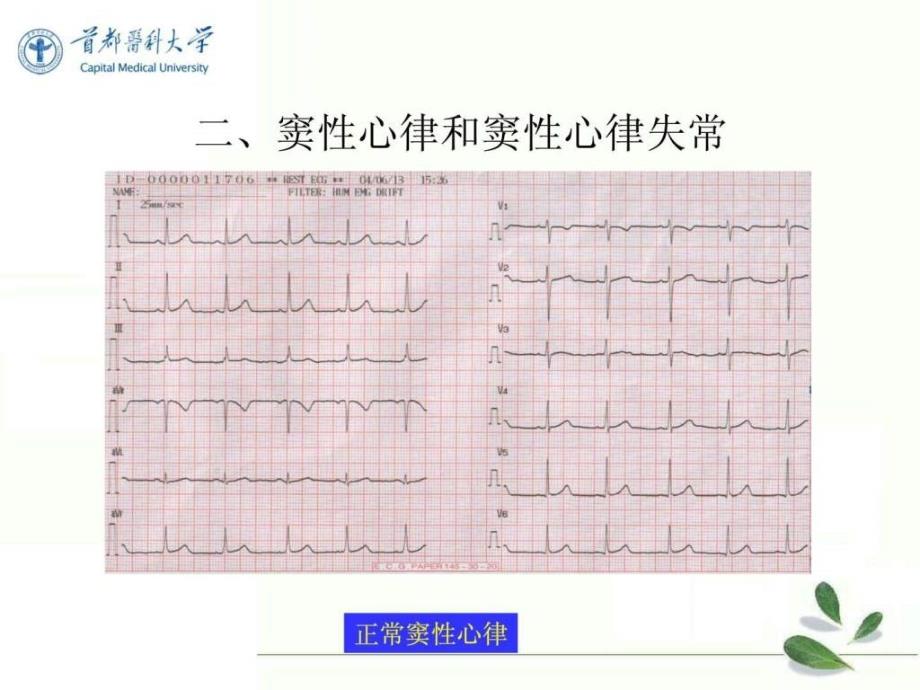 2.异常心电图心律失常.ppt_第4页