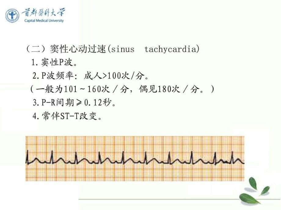 2.异常心电图心律失常.ppt_第5页