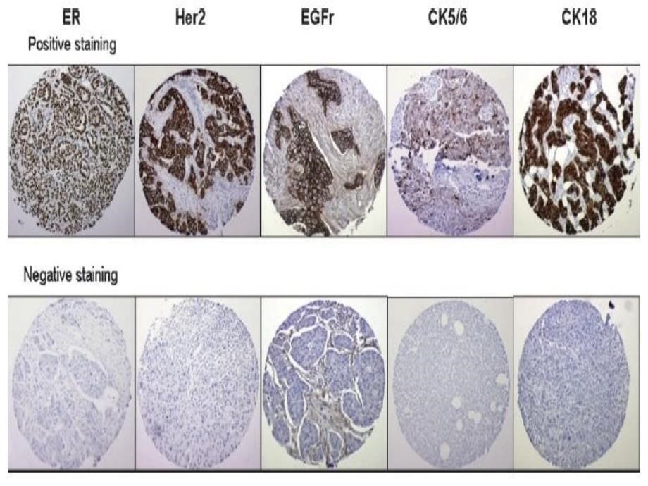 最新余之刚山东大学第二医院乳腺外科基底细胞样型乳腺癌精选PPT文档_第5页