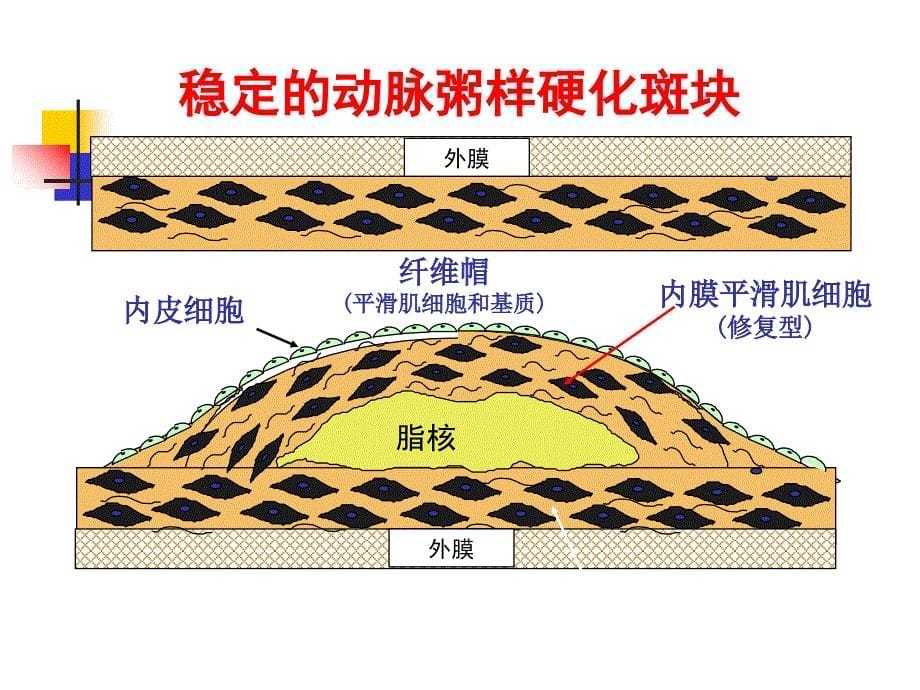 冠状动脉粥样硬化性心脏病_第5页