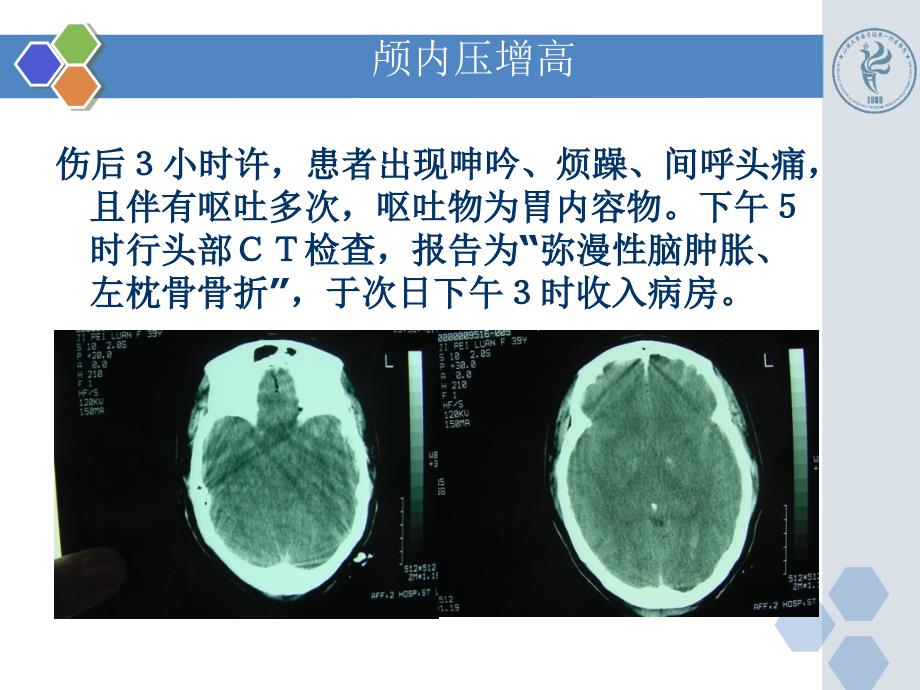 新版颅内压增高病例PPT_第4页