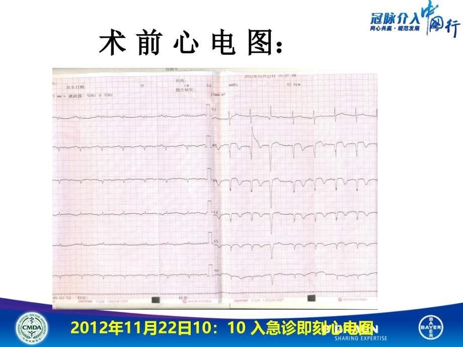 三只病变的急非ST段抬高心梗行急诊PCI治疗策略如何抉择_第5页