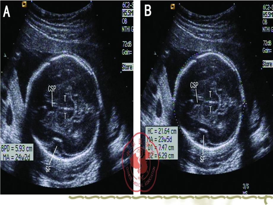 医学专题：中孕期胎儿超声检查标准切面_第4页