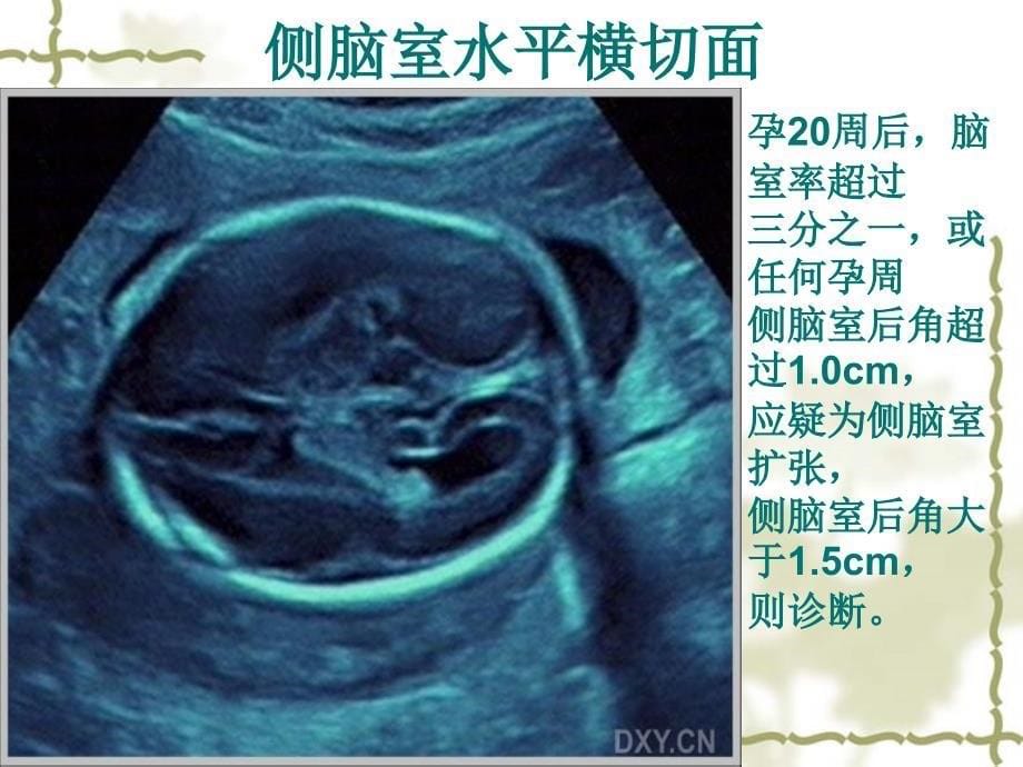 医学专题：中孕期胎儿超声检查标准切面_第5页