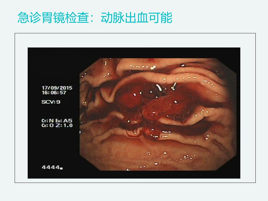 急诊急性消化道出血课件_第3页