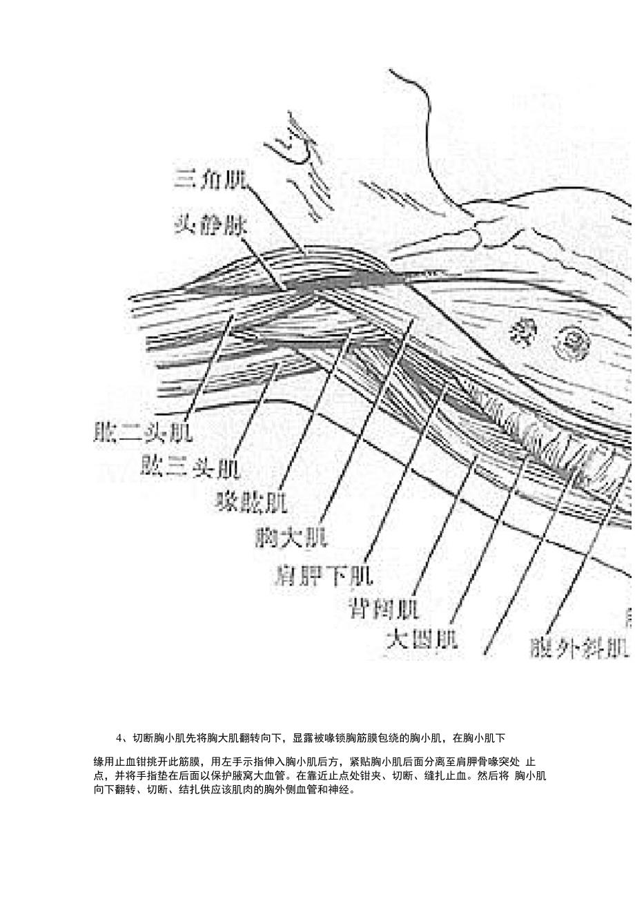 乳腺癌手术步骤_第3页