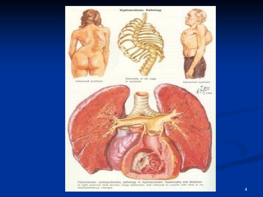 慢性肺源性心脏病教学专业研究_第4页