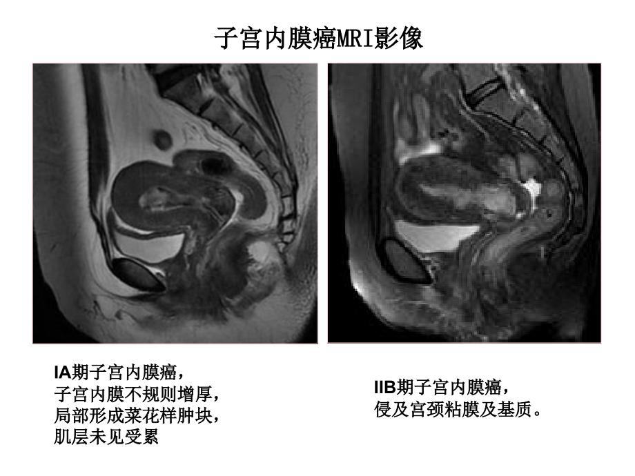 子宫内膜癌诊治面临的问题与挑战妇产科课件_第4页