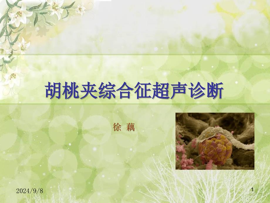 胡桃夹综合征课件_第1页