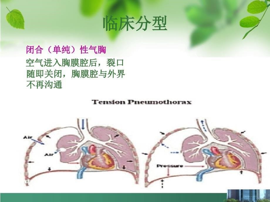 气胸护理查房课件_第5页