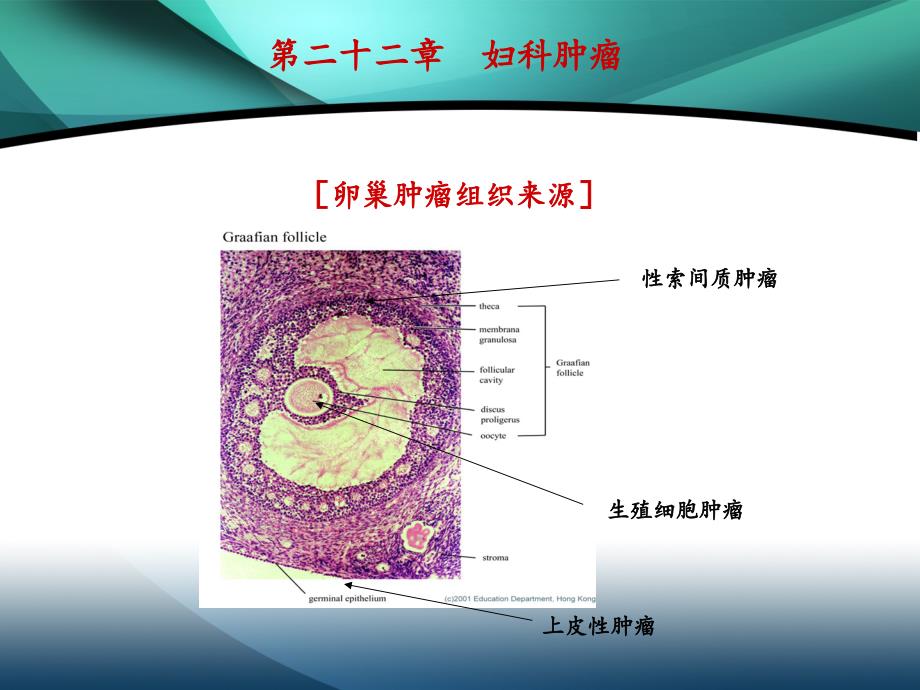 卵巢肿瘤课件_第4页