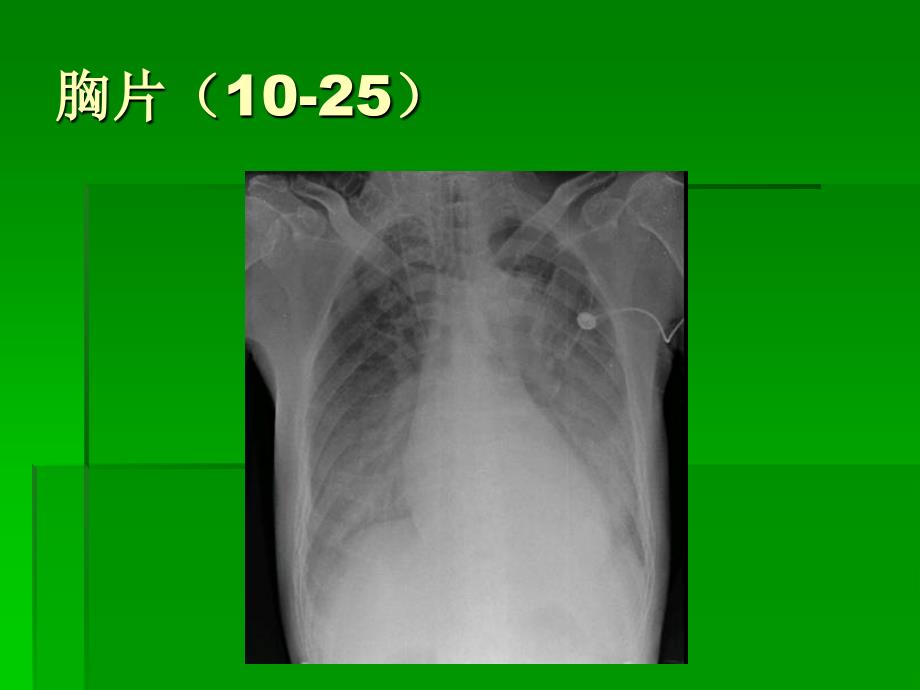 循证医学病例报告ICU心衰患者抗生素的合理化使用_第4页